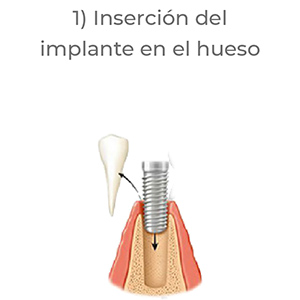 pasos implantes