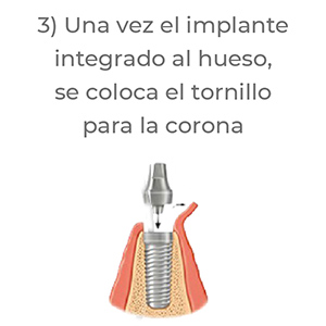 pasos implantes