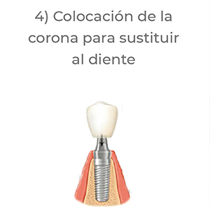 pasos implantes