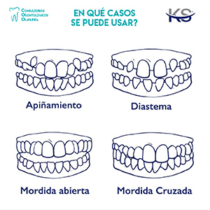 en que casos se puede usar ortodoncia invisible