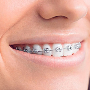 brackets metal