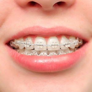 brackets estéticos