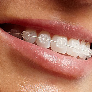 brackets zafiro
