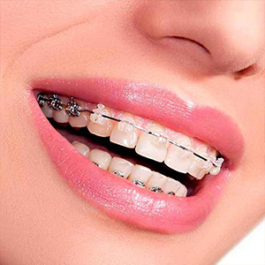 brackets ortodoncia